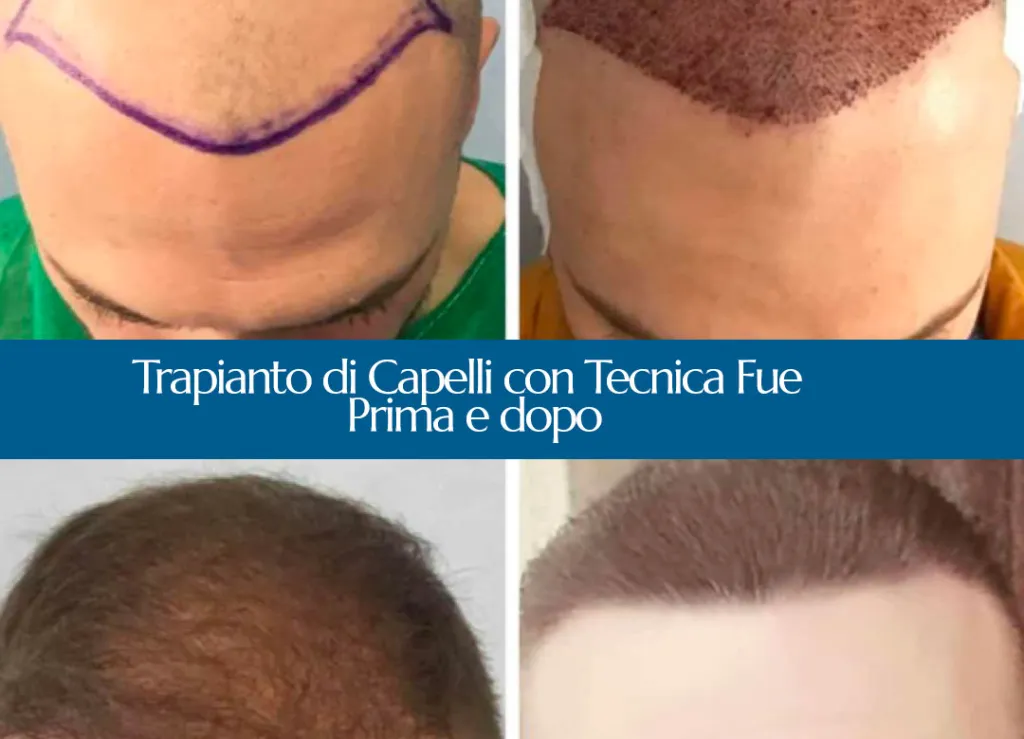 trapianto di capelli a firenze e Cosenza