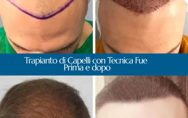 trapianto di capelli a firenze e Cosenza