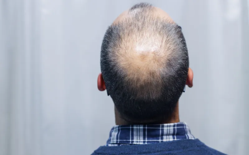 alopecia
