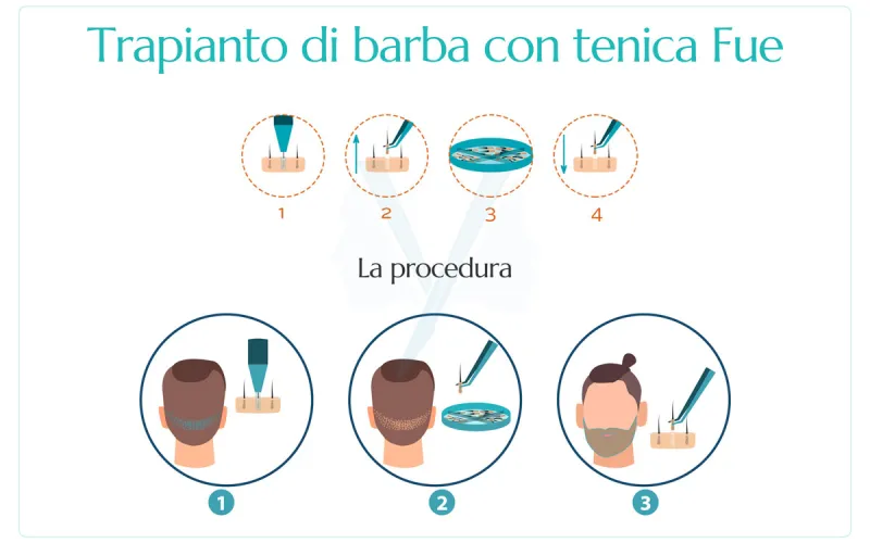 trapianto di barba con tecnica fue