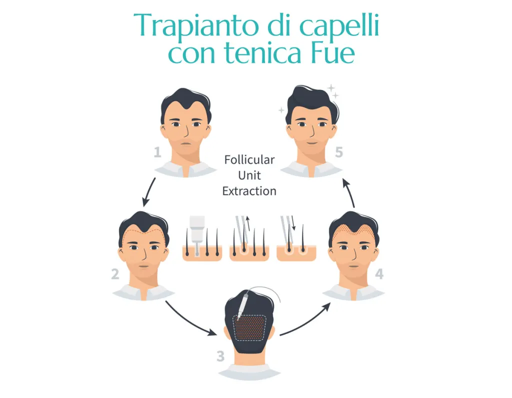 procedura del trapianto di capelli con tecnica fue effettuato dal dott. Valente a Firenze