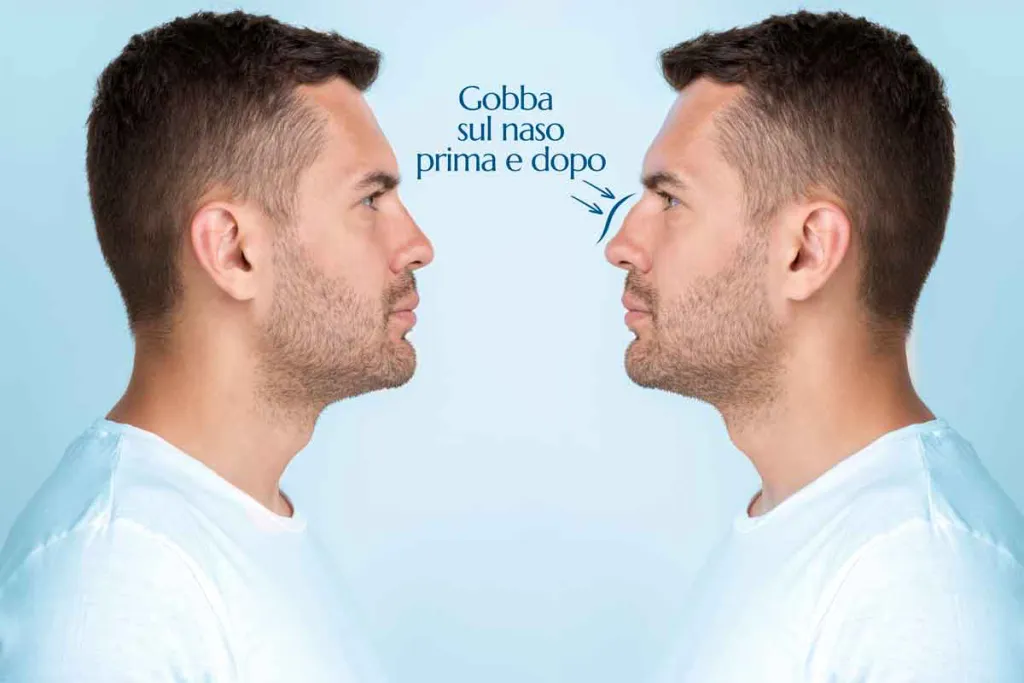 gobba sul naso prima e dopo