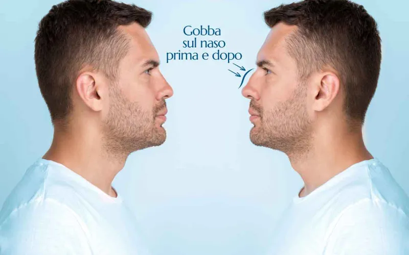 gobba sul naso prima e dopo